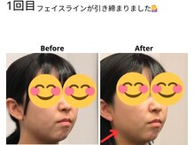 ベル/20代の方の小顔Before After
