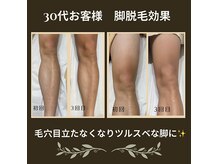 ☆メンズ両脚脱毛お客様効果☆大人気メニューでございます！