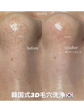 クレヴィー(Creviy)/韓国式3D毛穴洗浄(初回1回目)
