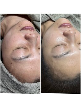 ラニー アンド ココネイル(LANIE&CocoNail)/夏の疲れたお肌をリセット！