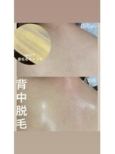 リエイト(Lieto)/背中コラボ脱毛