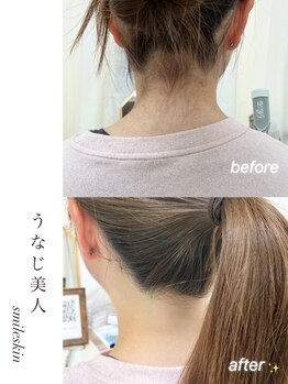 スマイルネイル(SMILE NAIL)/うなじ脱毛