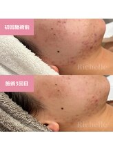 リシェル(Richelle)/ 【GREENPEELソフト1day】