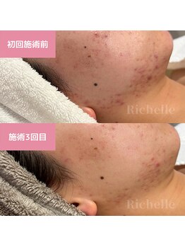 リシェル(Richelle)/ 【GREENPEELソフト1day】