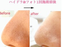 ララン(Laran)/ハイドラ＆光フェイシャル