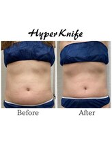 ハリルル 併設 GLケンタ鍼灸整骨院(HARILULU)/ハイパーナイフ　お腹集中