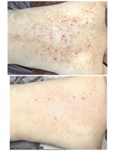 ビープラス(Biplus)/繰り返される背中ニキビ