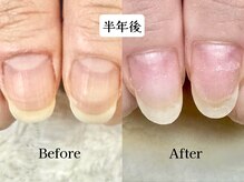 グラシナ なんば店/深爪/自爪育成/フィルイン