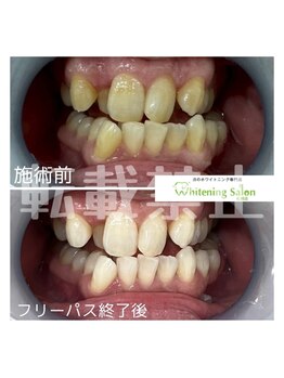 ホワイトニングサロン 札幌店/【ホワイトニング】#札幌#大通り