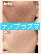 ヘッドミント 福井店/ナノプラズマ