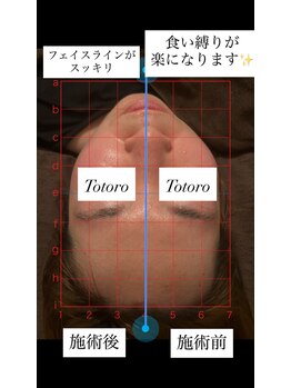 トトロ 明石大久保店(Totoro)/1回で変わる小顔矯正