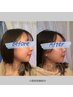おすすめ☆【小顔美容鍼60分】小顔美容鍼&低周波+ラジオ波&小顔筋膜¥13,000