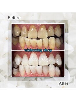 ホワイトニングショップ 太田店/ホワイトニングビフォーアフター
