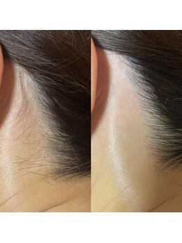 ザ サロン(THE SALON)/1度でツルツルに♪うなじWAX脱毛