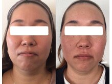 エムズサロン(m’sサロン)/初回→12回のビフォーアフター