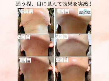 美肌研究所 東京新宿支店/改善までの経過写真