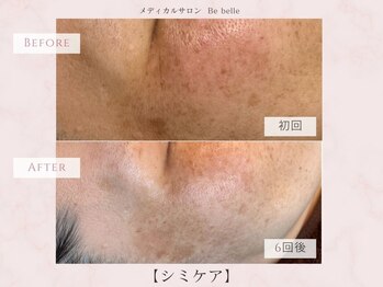 ビベル 八木店(Bebelle)/50代のシミ集中ケア