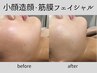 【背面から変える小顔】背中ケア付◆小顔筋膜Rフェイシャル90分¥22000⇒