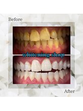 ホワイトニングショップ 太田店/ホワイトニングビフォーアフター