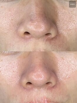 ホワイトアクア 京都店(WHITE AQUA)/ララピール/毛穴/京都