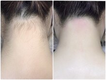 カルム(Calme)/うなじ脱毛