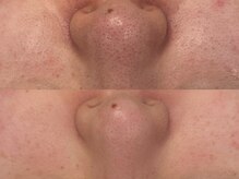 ベアール(beal)/毛穴特化ハーブピーリング