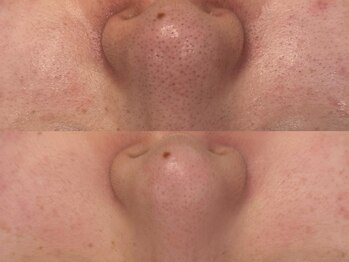 ベアール(beal)/毛穴特化ハーブピーリング