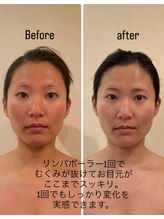 アンリール(ANRIRE)/リンパボーラー1回でこの効果