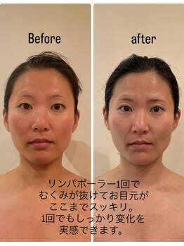 アンリール(ANRIRE)/リンパボーラー1回でこの効果