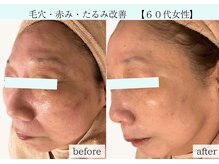 パリス(PALIS)の雰囲気（開き毛穴・赤み・たるみ改善の症例☆その他症例はフォトに掲載♪）