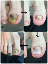 ココ ネイル サロン アンドスクール(COCO.NAIL SALON＆SCHOOL)/トラブルフット 肥厚爪