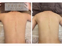 セブンフォリオ(7FORIO)/赤みが取れたら透明感が出ました