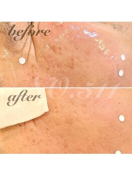 ナンバー511(No.511)/シミケア