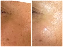 アデル(Adele)/リブセラフェイシヤル