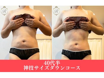 ルフレ(REFLET)/【事例2】Before/After/痩身