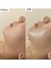 【2回目以降はこちら】【お顔】半永久効果！脂肪分解剤ダウンタイムなし！