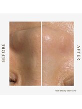 リノ(Lino)/BeforeAfter