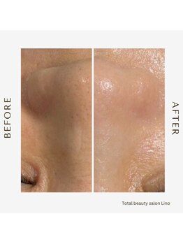 リノ(Lino)/BeforeAfter