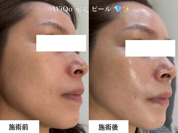 ウィ アネラ(U'i Anela)/WiQo 水光ピール