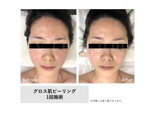 スリール(sourire)/Gloss肌ピーリング