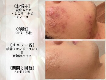 アクール(Accueil)/【ニキビ・跡】