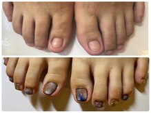 足の深爪も可能です、夢のネイルデザインもかわいく楽しめます♪