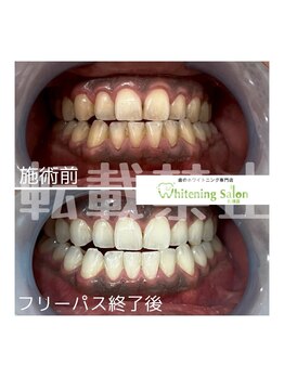 ホワイトニングサロン 札幌店/【ホワイトニング】#札幌#大通り