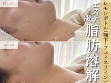 アポシェ(apoche)/小顔/輪郭形成/二重顎/脂肪分解