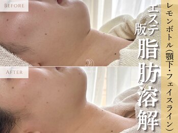 アポシェ(apoche)/小顔/輪郭形成/二重顎/脂肪分解