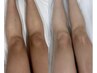 【つるんと透明感】選べる1部位 ボディピーリング 再来14900→初回 ¥11900
