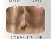 美Rの雰囲気（毛穴の開き・黒ずみ・詰まりに！本気の毛穴ケアで理想の素肌へ）