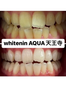 アクア 天王寺店(AQUA)/セルフホワイトニング効果