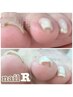 nail R☆巻き爪補正2箇所&フットケア&足裏角質ケア&ワンカラー¥14200→¥13800