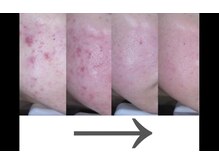 マイン イオンモール浜松市野店/ドクターリセラADS美肌活性